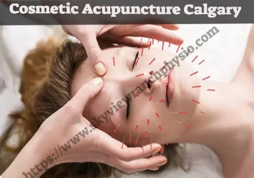 cosmetic acupuncture calgary